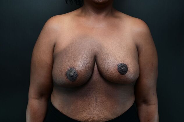 Oncoplastic Breast Reduction: Case 1 - After