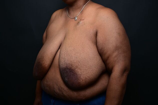 Breast Reduction: Case 14 - Before