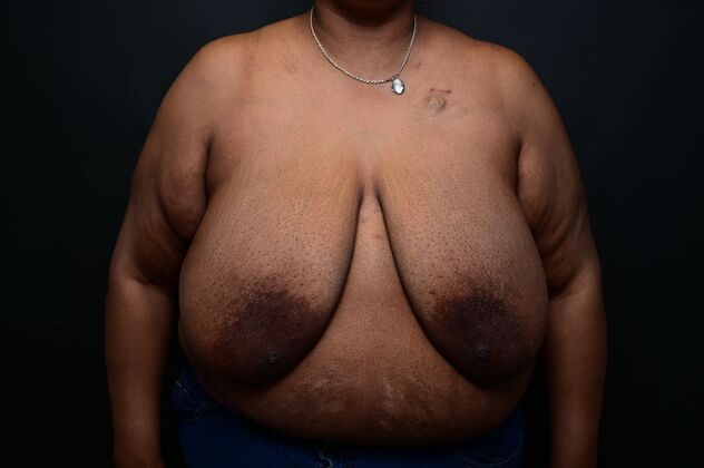 Breast Reduction: Case 14 - Before