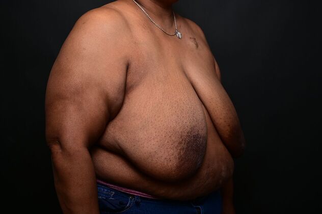 Breast Reduction Case 14 - Before