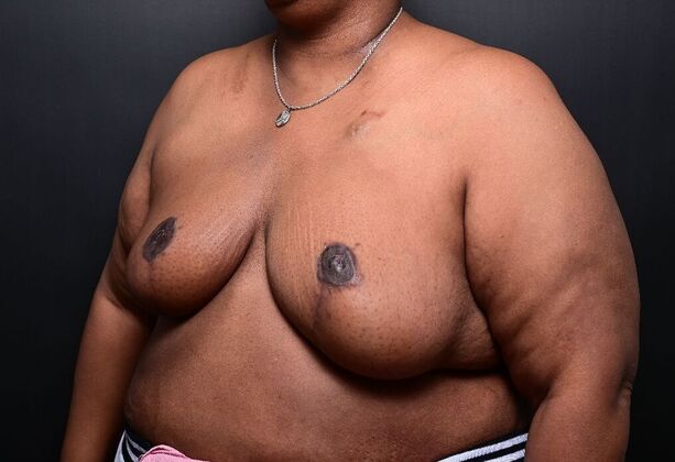 Breast Reduction: Case 14 - After