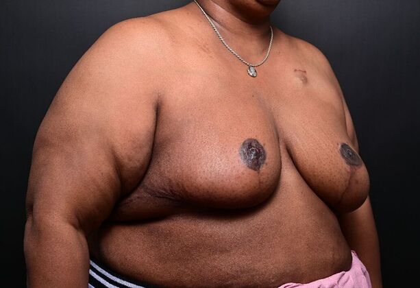 Breast Reduction Case 14 - After