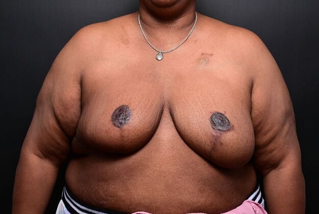 Breast Reduction: Case 14 - After