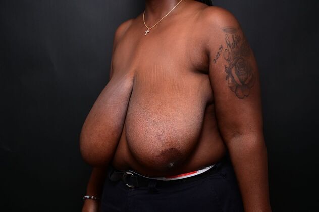 Breast Reduction: Case 16 - Before