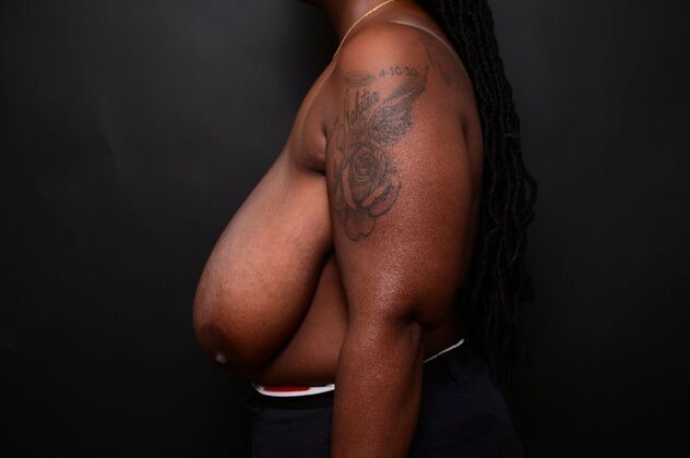 Breast Reduction: Case 16 - After