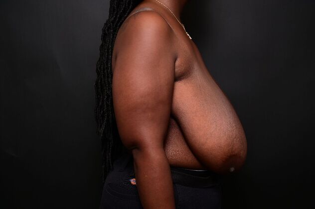 Breast Reduction: Case 16 - Before