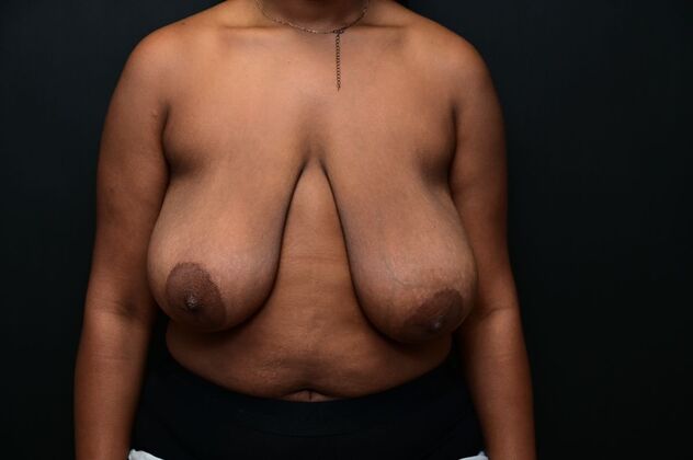 Breast Reduction: Case 17 - Before