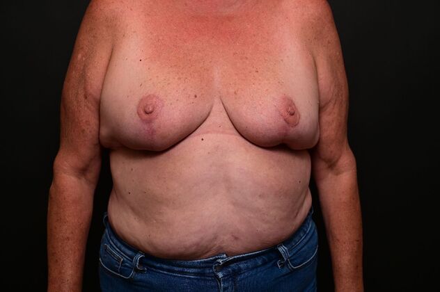 Breast Reduction: Case 18 - After