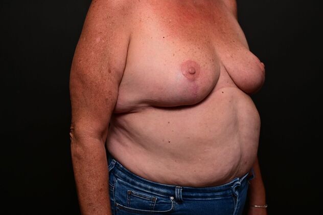 Breast Reduction Case 18 - After