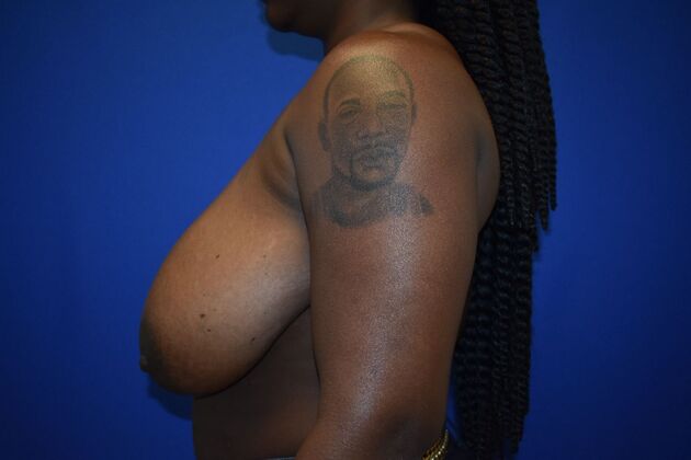 Breast Reduction: Case 19 - Before