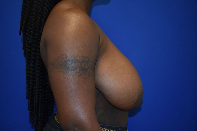 Breast Reduction: Case 19 - Before
