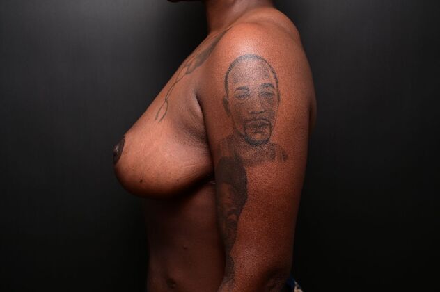 Breast Reduction: Case 19 - After