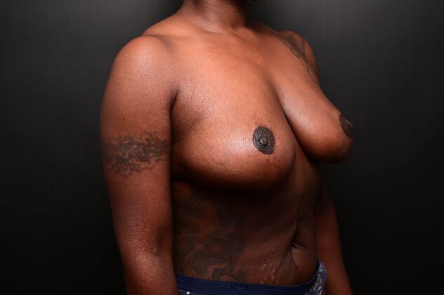 Breast Reduction Case 19 - After