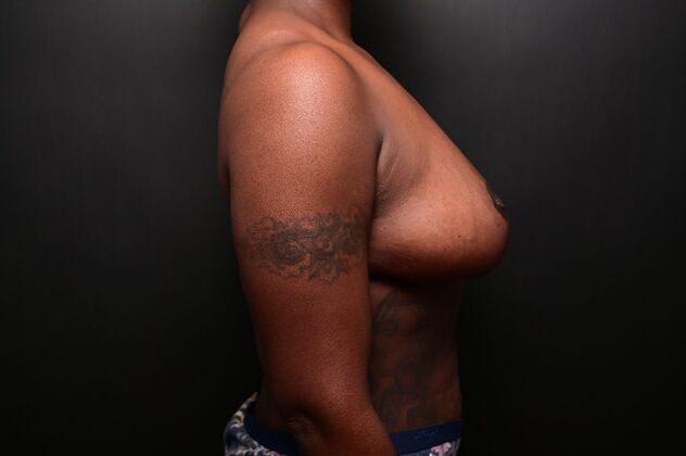 Breast Reduction: Case 19 - After