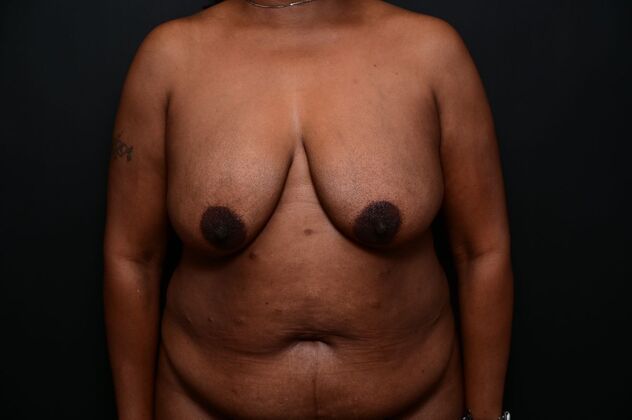 Breast Reduction: Case 20 - Before