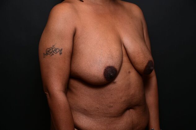 Breast Reduction Case 20 - Before