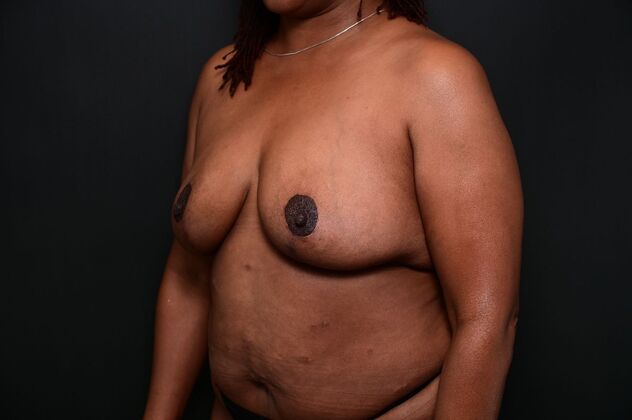 Breast Reduction: Case 20 - After