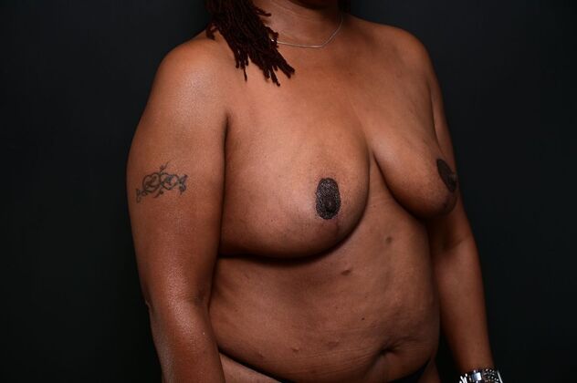 Breast Reduction Case 20 - After