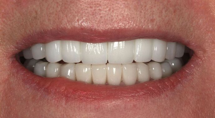 Dental Implants Case 4 - After