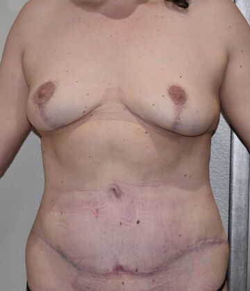 Mommy Makeover: Case 21 - After