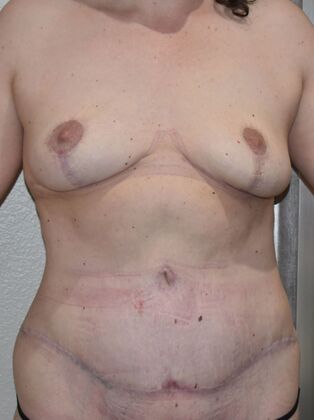 Mommy Makeover Case 21 - After