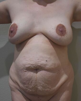 Mommy Makeover: Case 21 - Before