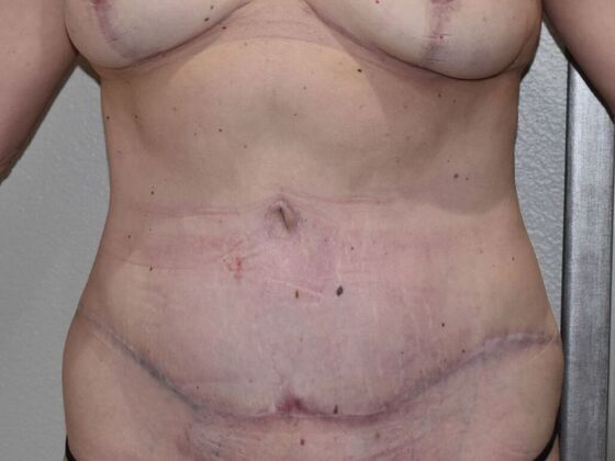 Tummy Tuck (Abdominoplasty): Case 27 - After