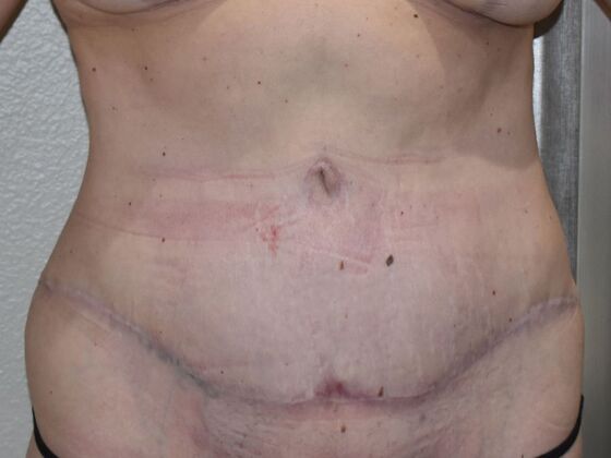 Tummy Tuck (Abdominoplasty): Case 27 - After