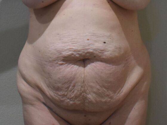 Tummy Tuck (Abdominoplasty): Case 27 - Before