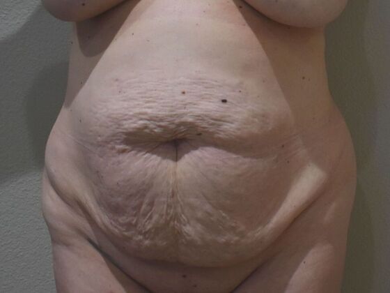 Tummy Tuck (Abdominoplasty): Case 27 - Before