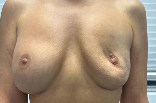 Breast Revision: Case 362 - Before