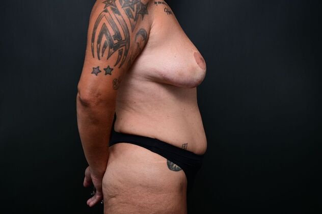 Mini Tummy tuck : Case 2 - Before