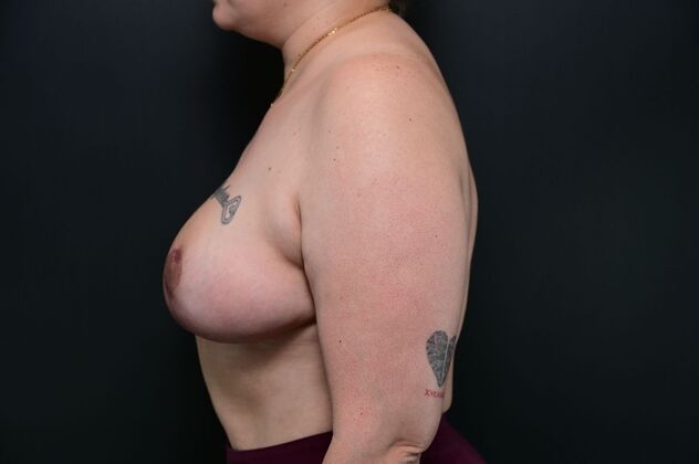 Oncoplastic Breast Reduction: Case 5 - Before
