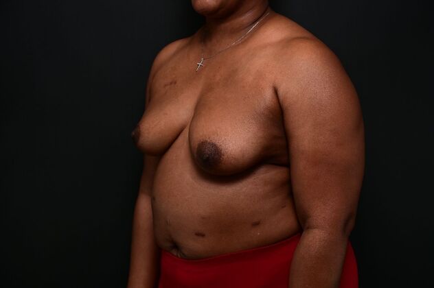 Oncoplastic Breast Reduction Case 6 - Before