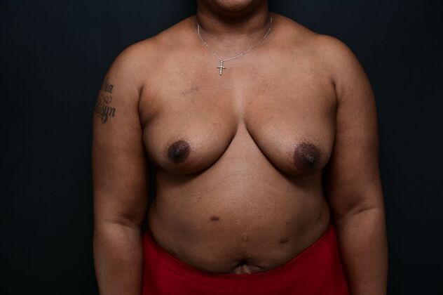Oncoplastic Breast Reduction: Case 6 - Before