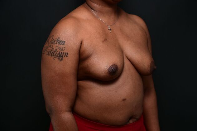 Oncoplastic Breast Reduction: Case 6 - Before