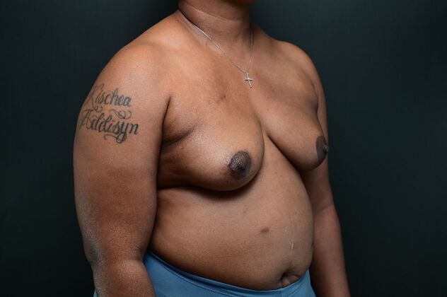 Oncoplastic Breast Reduction: Case 6 - After