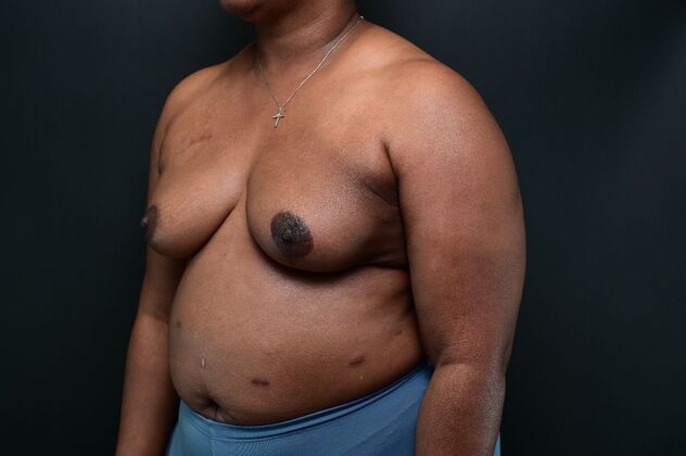 Oncoplastic Breast Reduction Case 6 - After