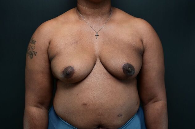 Oncoplastic Breast Reduction: Case 6 - After