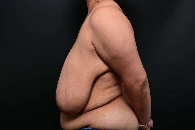 Breast Reduction: Case 22 - Before
