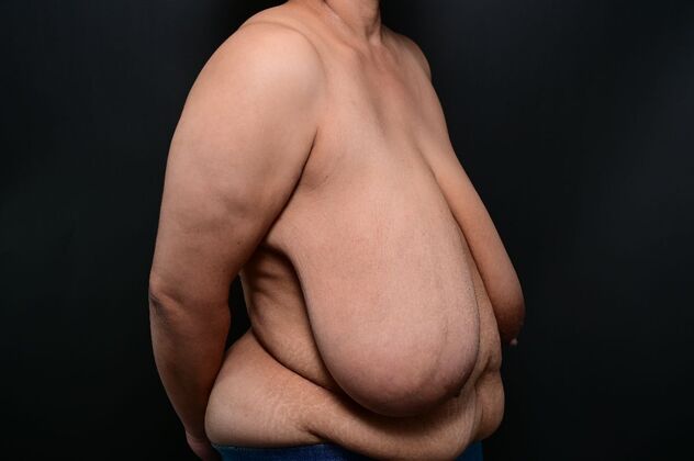 Breast Reduction Case 22 - Before