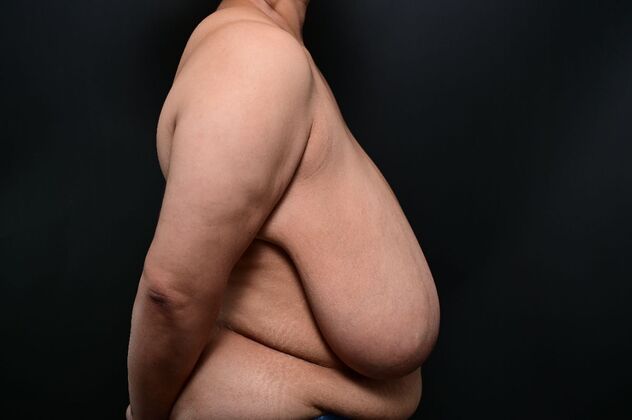 Breast Reduction: Case 22 - After