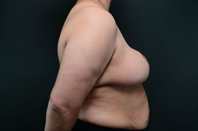 Breast Reduction: Case 22 - Before