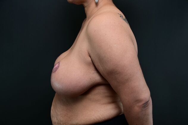 Breast Reduction: Case 22 - After
