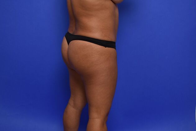 Brazilian Butt Lift Case 7 - Before