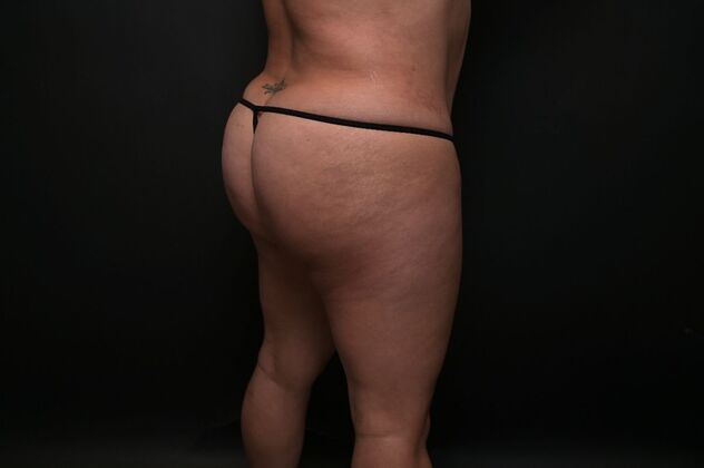 Brazilian Butt Lift Case 7 - After