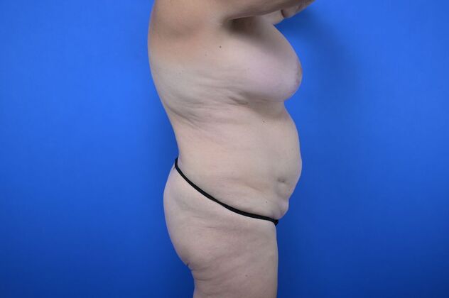 Tummy Tuck with LipoContouring: Case 11 - Before