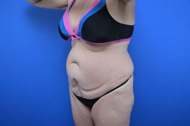 Tummy Tuck with LipoContouring: Case 11 - Before