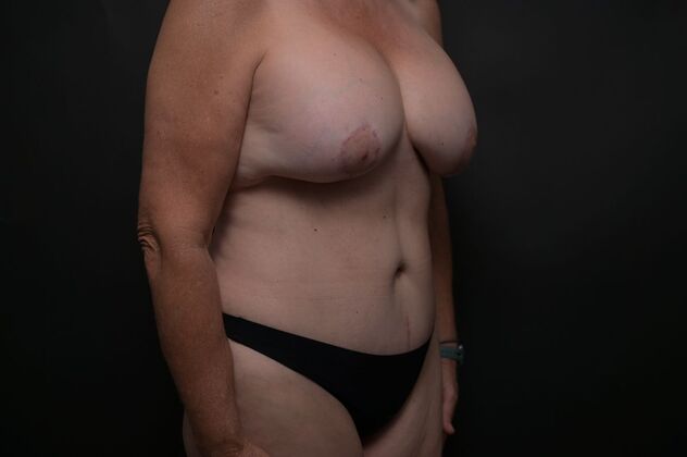 Tummy Tuck with LipoContouring: Case 11 - After
