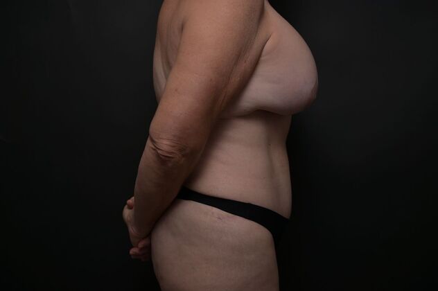 Tummy Tuck with LipoContouring: Case 11 - After